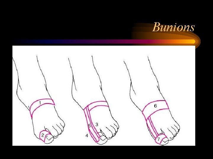 Bunions 