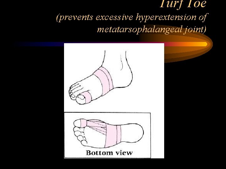 Turf Toe (prevents excessive hyperextension of metatarsophalangeal joint) 