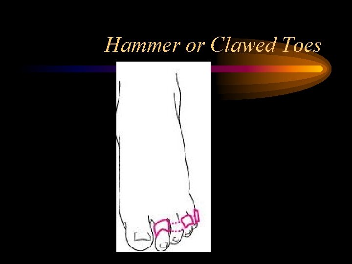 Hammer or Clawed Toes 