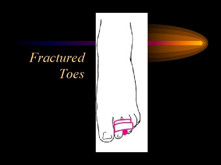 Fractured Toes 