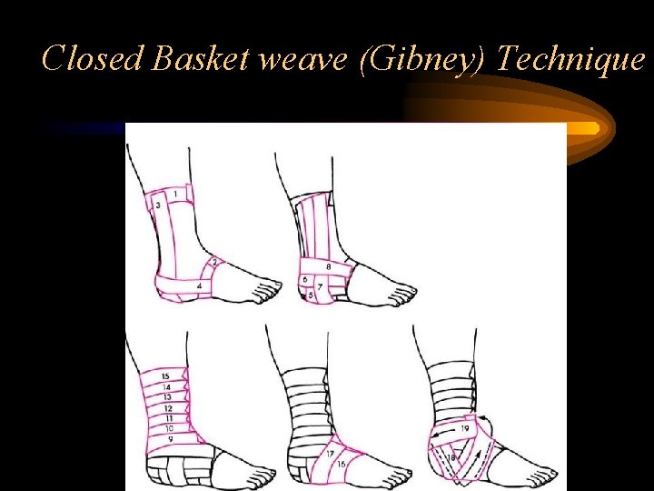 Closed Basket weave (Gibney) Technique 