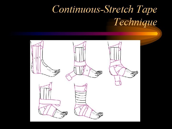 Continuous-Stretch Tape Technique 