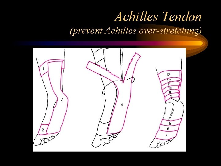 Achilles Tendon (prevent Achilles over-stretching) 