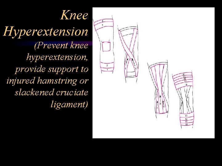 Knee Hyperextension (Prevent knee hyperextension, provide support to injured hamstring or slackened cruciate ligament)