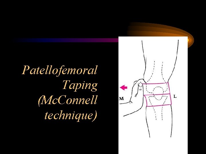 Patellofemoral Taping (Mc. Connell technique) 