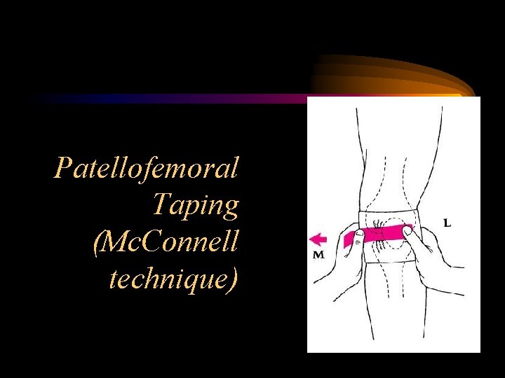 Patellofemoral Taping (Mc. Connell technique) 