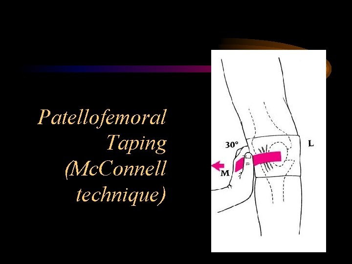 Patellofemoral Taping (Mc. Connell technique) 