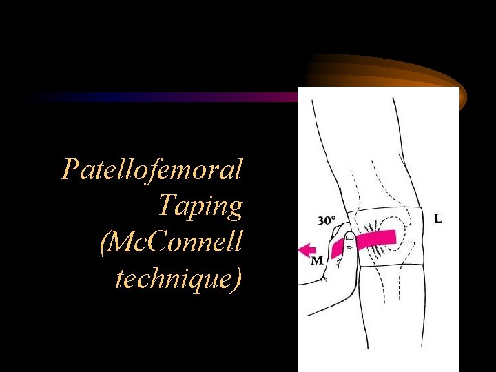 Patellofemoral Taping (Mc. Connell technique) 