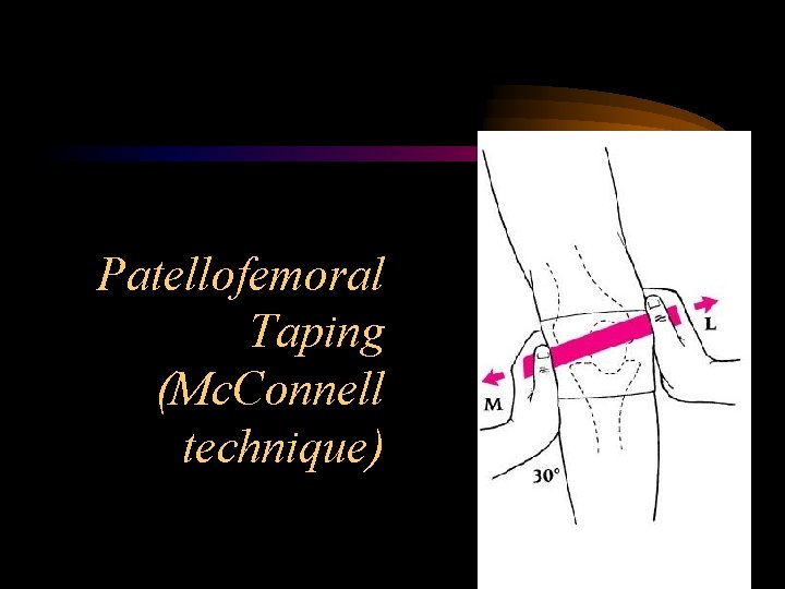 Patellofemoral Taping (Mc. Connell technique) 