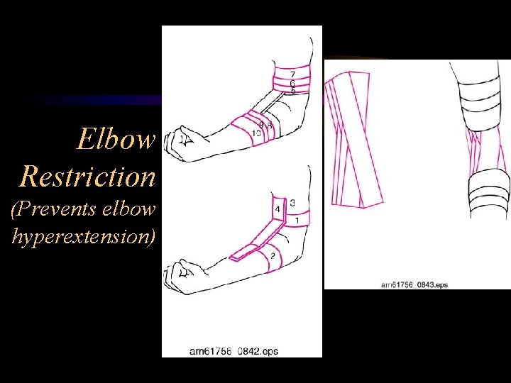 Elbow Restriction (Prevents elbow hyperextension) 