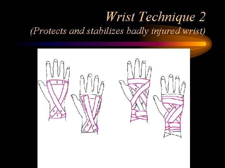 Wrist Technique 2 (Protects and stabilizes badly injured wrist) 