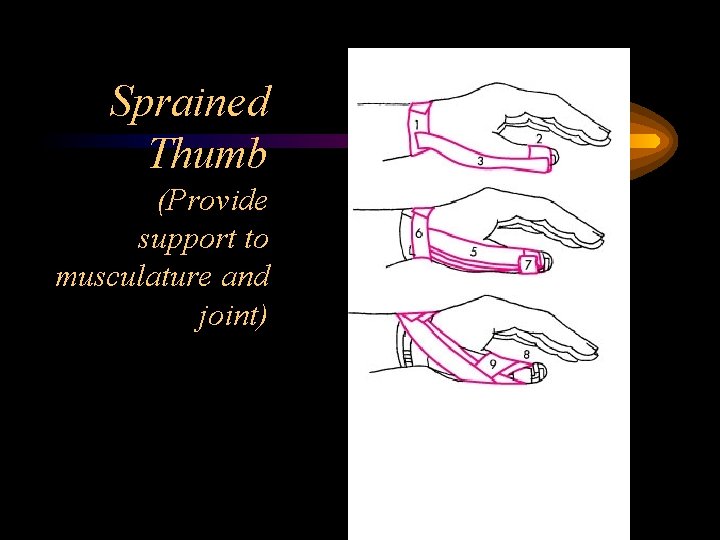 Sprained Thumb (Provide support to musculature and joint) 