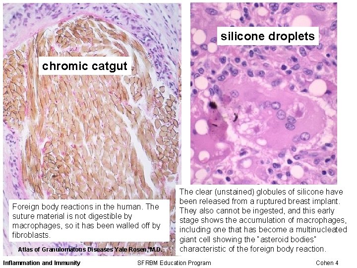 silicone droplets chromic catgut Foreign body reactions in the human. The suture material is