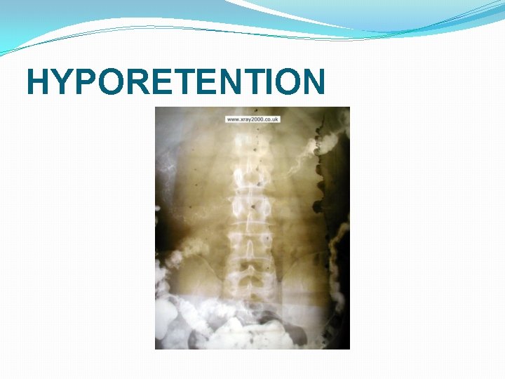 HYPORETENTION 