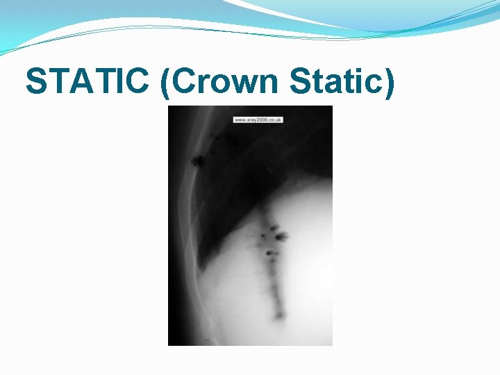 STATIC (Crown Static) STATIC (Crown Static)