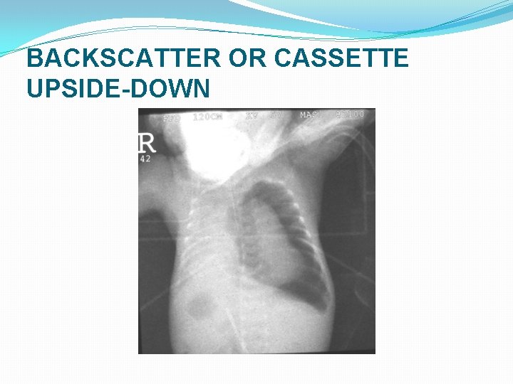 BACKSCATTER OR CASSETTE UPSIDE-DOWN BACKSCATTER OR CASSETTE UPSIDE-DOWN