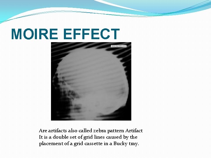 MOIRE EFFECT Are artifacts also called zebra pattern Artifact It is a double set