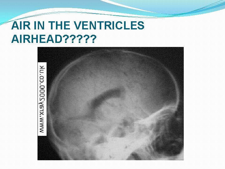 AIR IN THE VENTRICLES AIRHEAD? ? ? 