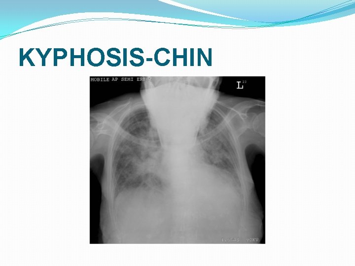 KYPHOSIS-CHIN 