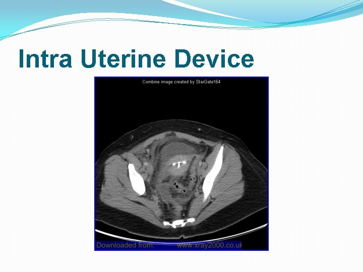 Intra Uterine Device 