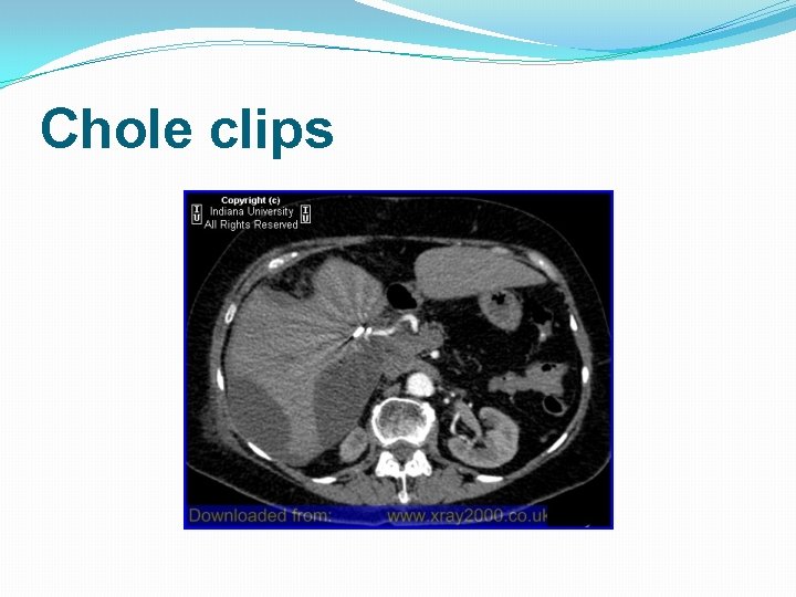 Chole clips Chole clips