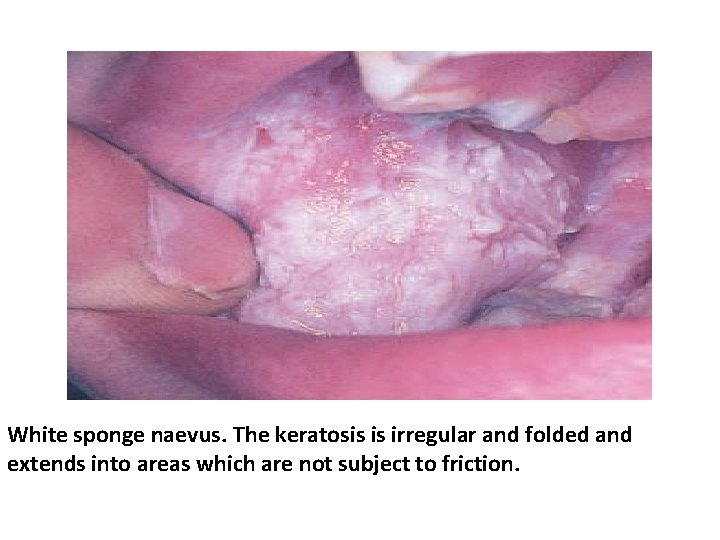 White sponge naevus. The keratosis is irregular and folded and extends into areas which