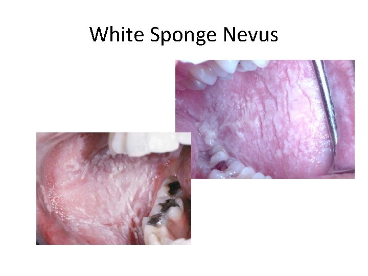 White Sponge Nevus 