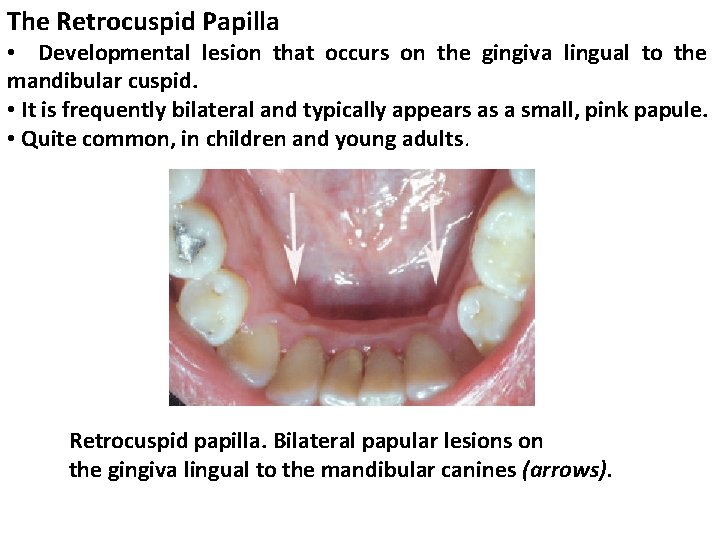 The Retrocuspid Papilla • Developmental lesion that occurs on the gingiva lingual to the