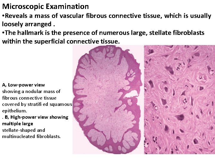 Microscopic Examination • Reveals a mass of vascular fibrous connective tissue, which is usually