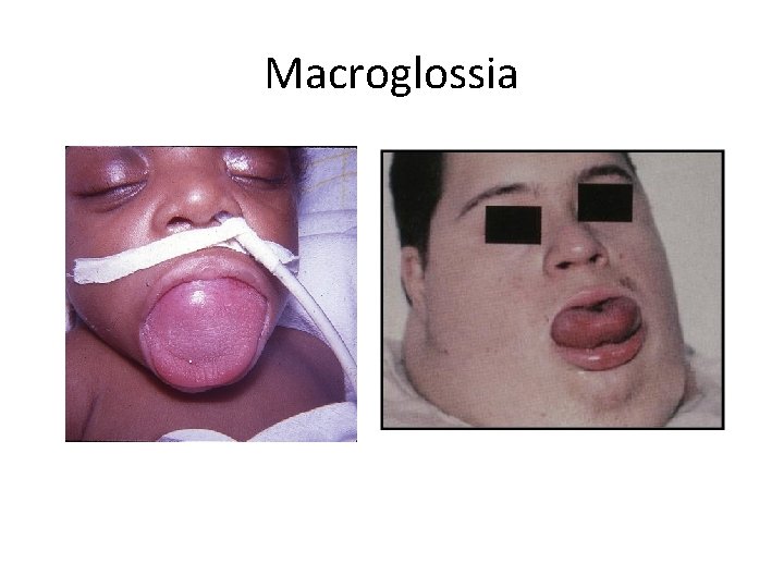 Macroglossia 