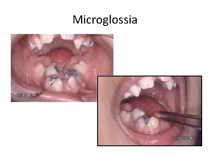 Microglossia 