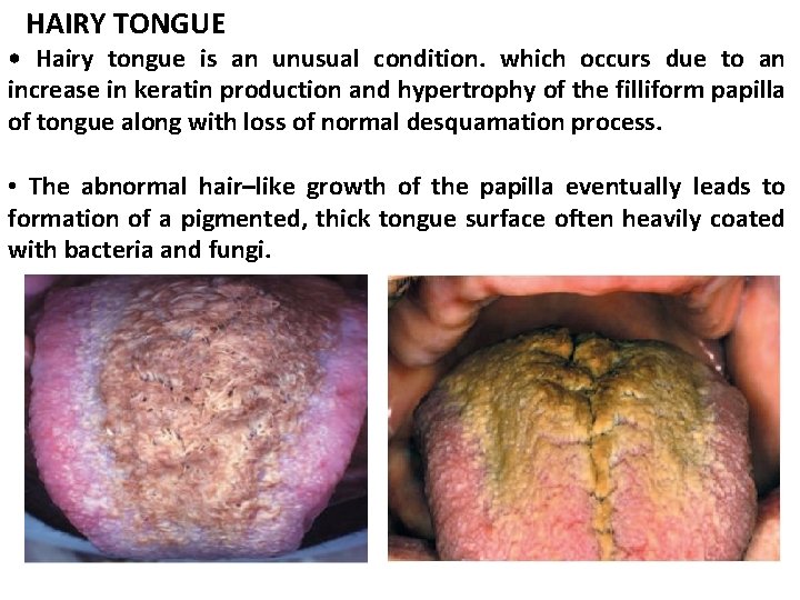 HAIRY TONGUE • Hairy tongue is an unusual condition. which occurs due to an