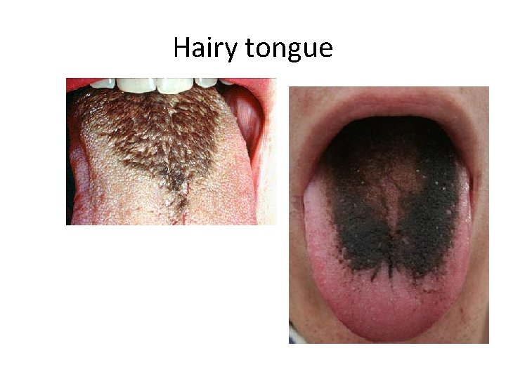 Hairy tongue 