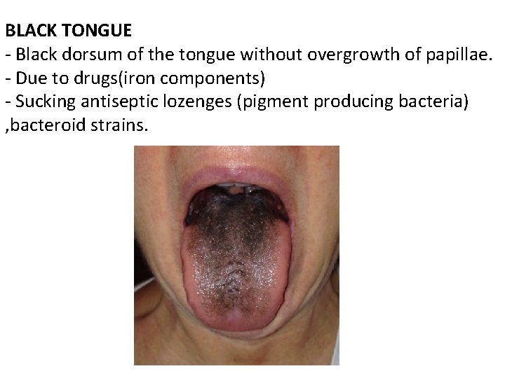 BLACK TONGUE - Black dorsum of the tongue without overgrowth of papillae. - Due