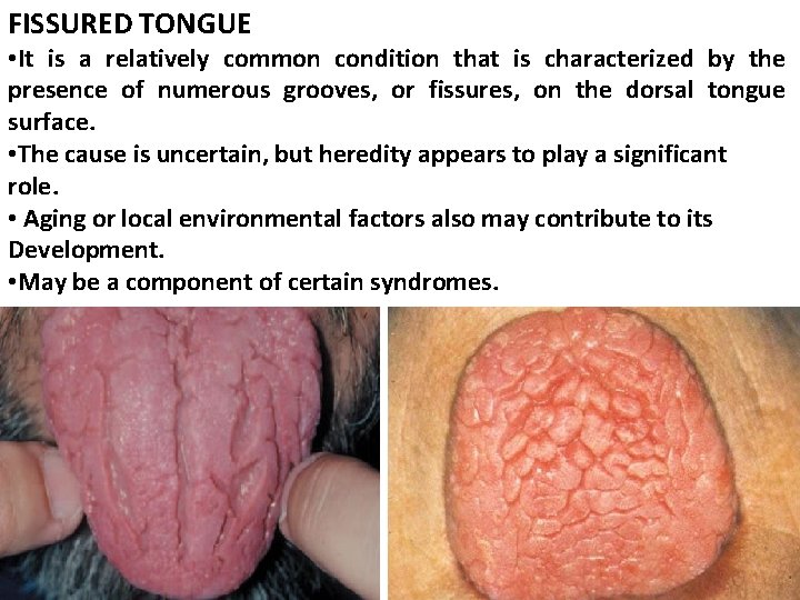 FISSURED TONGUE • It is a relatively common condition that is characterized by the