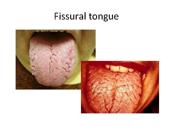 Fissural tongue 