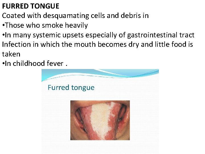 FURRED TONGUE Coated with desquamating cells and debris in • Those who smoke heavily