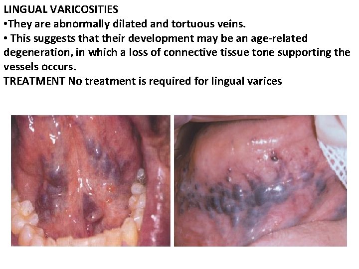 LINGUAL VARICOSITIES • They are abnormally dilated and tortuous veins. • This suggests that