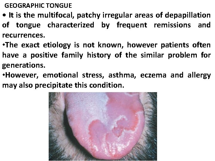 GEOGRAPHIC TONGUE • It is the multifocal, patchy irregular areas of depapillation of tongue