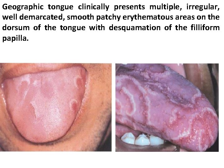 Geographic tongue clinically presents multiple, irregular, well demarcated, smooth patchy erythematous areas on the