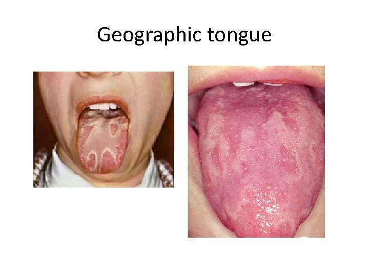 Geographic tongue 