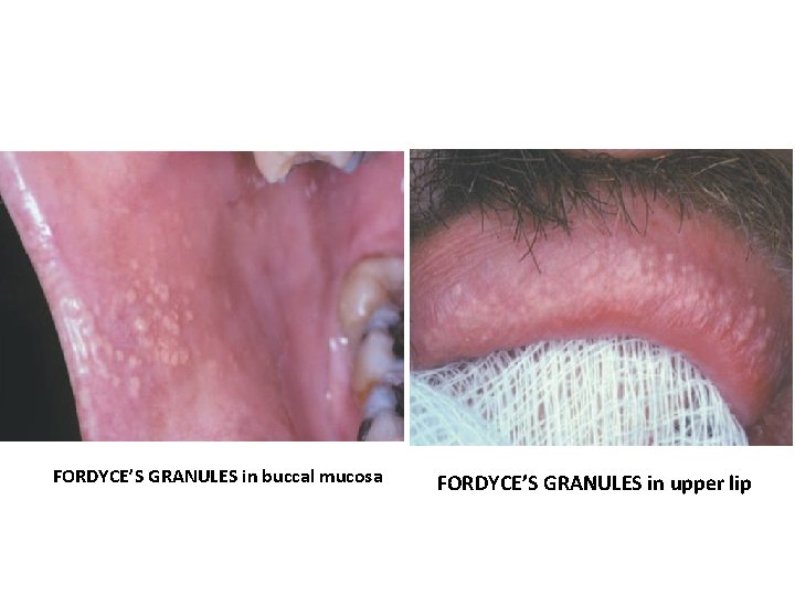 FORDYCE’S GRANULES in buccal mucosa FORDYCE’S GRANULES in upper lip 