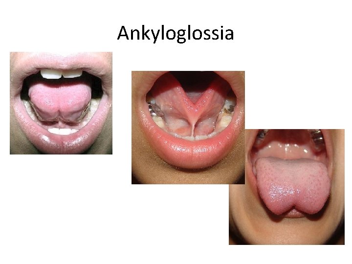 Ankyloglossia 