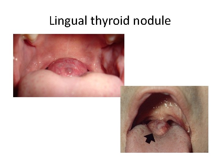 Lingual thyroid nodule 