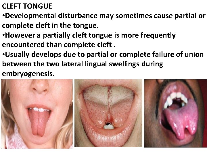 CLEFT TONGUE • Developmental disturbance may sometimes cause partial or complete cleft in the