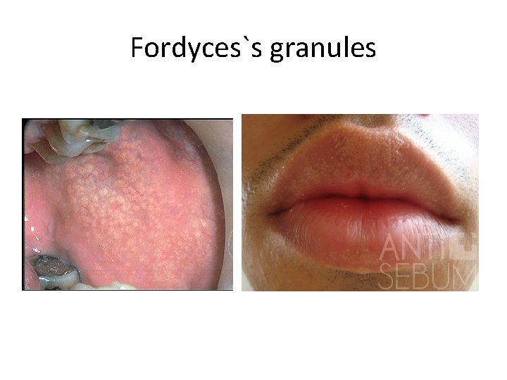 Fordyces`s granules 