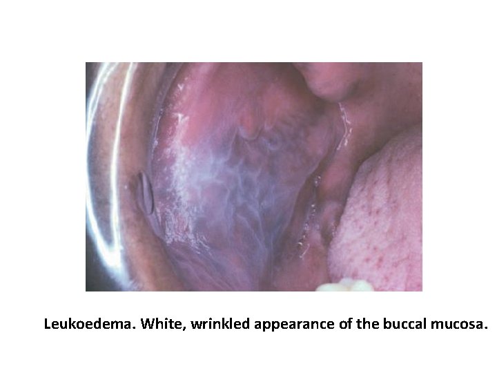 Leukoedema. White, wrinkled appearance of the buccal mucosa. 