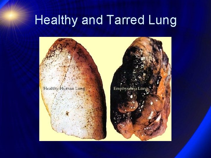 Healthy and Tarred Lung 