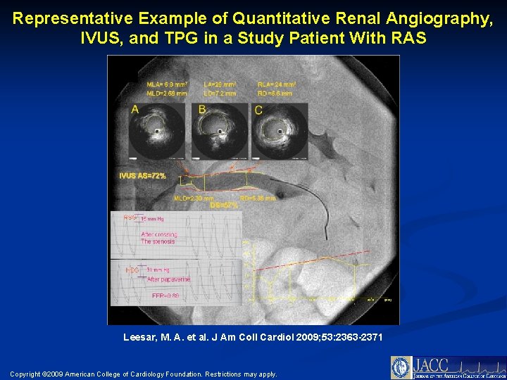 Representative Example of Quantitative Renal Angiography, IVUS, and TPG in a Study Patient With