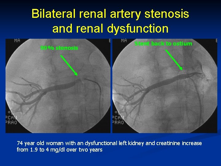 Bilateral renal artery stenosis and renal dysfunction 99% stenosis Stent back to ostium 74